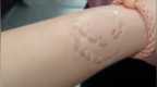 女子乘火车卧铺被占，争吵中手腕被咬起疱疹，当事人：怕对方有传染病