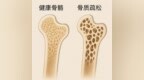骨头“偷偷变脆”？济南南郊医院医生教你科学护骨