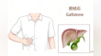 小小结石隐患大 科学护胆防未病