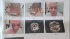 男子就餐提醒邻桌“小点声”遭殴打致伤，至今肇事者还没找到，伤者急需手术