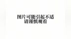 全国知名专家进驻八医 | 精准“穿”越险境，一针引流转危为安——东院超声科成功完成高难度PTCD手术，挽救危重患者