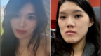 做正颌手术反成“鞋拔子脸”的女孩：已向卫健委提交新证据