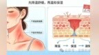 晒红发烫脱皮别乱敷　夏季晒伤修复的正确姿势