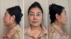 女子花170万整形后鼻子歪了、额头坑洼不平，整形机构曾被曝非法行医
