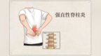 年轻人反复腰背痛 警惕强直性脊柱炎