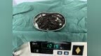 36岁男子胃中取出180颗铁钉 合计重量近1公斤