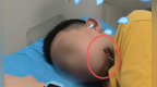 长沙12岁男孩湖边玩耍被它一口“咬”脸！暑假尚未结束，家长们注意了