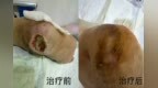 告别深层感染与肉芽不长！中西医结合“三位一体”疗法为糖足保肢