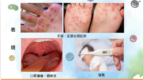 衞生局接獲1宗腸病毒羣集性感染報告