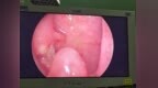 罕见！“呼噜娃”不都是感冒鼻炎、腺样体肥大，竟是3厘米毛状息肉堵了宝宝“嗓子眼”