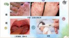 衞生局接獲1宗腸病毒羣集性感染報告