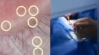一阵风吹过，男子眼睛扎入100根细刺，还带倒钩！入秋了，紧急提醒