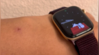 苹果Apple Watch S12被曝引发皮肤不适！有用户佩戴后手腕发红、出现灼烧感