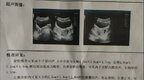 罕见！妊娠合并双子宫、双宫颈、双阴道
