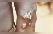 日本飙升的梅毒，到底是什么毒？