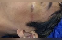 王力宏回应“演唱会摔倒满脸是血”：缝了27针才把耳朵重新缝合，脸上伤口缝了12针
