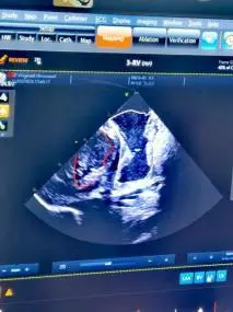 医工创谷企业动态：重大突破！国产双腔无导线起搏器研制成功，实现0到1原创性突破