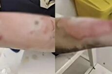 罗马仕充电宝自燃致三度烧伤事故：非召回批次产品