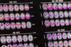 “滴血测痴呆”时代来临