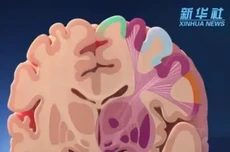 中国科学家世界首次发现帕金森病底层功能网络机制