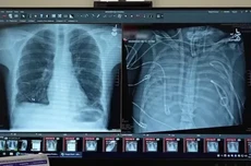 全球首例：人工肺支撑患者存活48小时，成功等到新肺移植