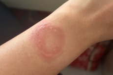 苹果Apple Watch灼伤手腕！更痛的是心寒：维权半年处处碰壁