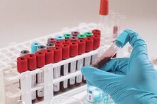 新型AI模型可通过血检识别多种神经退行性疾病