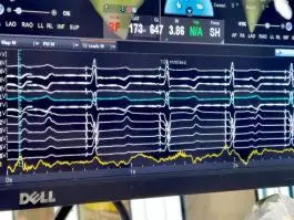 医工创谷企业动态：重大突破！国产双腔无导线起搏器研制成功，实现0到1原创性突破