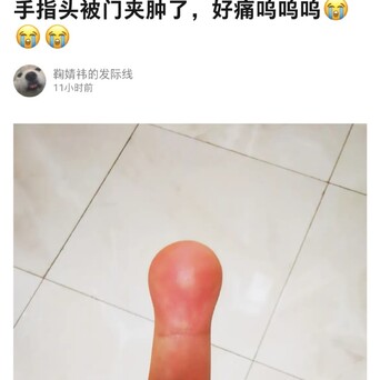 一根手指真能肿成两根大,《猫和老鼠》诚不欺我…_凤凰网娱乐_凤凰网
