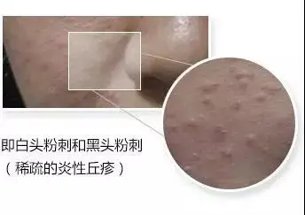 脸上长痘痘能不能抠 自我鉴定是否需要挤痘痘 挤痘痘到什么程度停