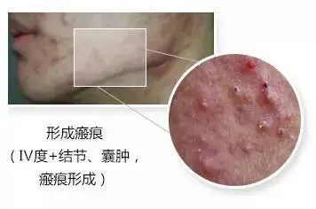 脸上长痘痘能不能抠 自我鉴定是否需要挤痘痘 挤痘痘到什么程度停