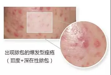 脸上长痘痘能不能抠 自我鉴定是否需要挤痘痘 挤痘痘到什么程度停