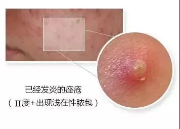 脸上长痘痘能不能抠 自我鉴定是否需要挤痘痘 挤痘痘到什么程度停