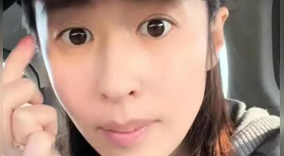 颖儿去做眼皮热玛吉 白眼球充血 直流眼泪 疼的直喊妈 真是花钱找罪受