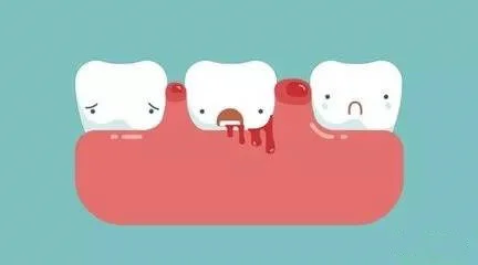 高伟丽详解| 牙周病的7大典型症状和治疗方法(牙周病最有效的治疗措施)