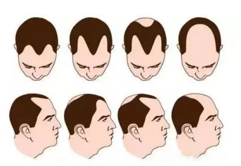 科普小常识：为什么大多数的脱发，都是从前额开始？插图2