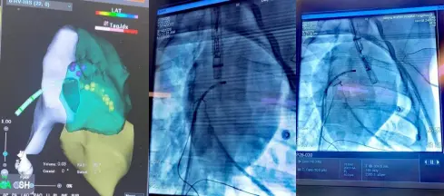 医工创谷企业动态：重大突破！国产双腔无导线起搏器研制成功，实现0到1原创性突破