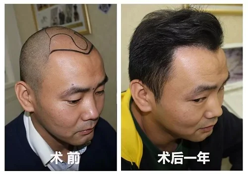发际线植发一般要多长时间，（发际线植发可以维持多久呢）-  新麦盛网(图2)