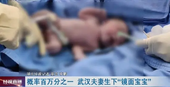出现概率仅百万分之一 武汉一孕妈诞下罕见“镜面宝宝”-武汉孕妇花光20万放弃治疗