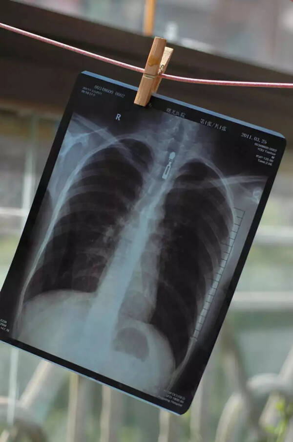 求职三个月无奈做了四次胸透,入职体检何时能