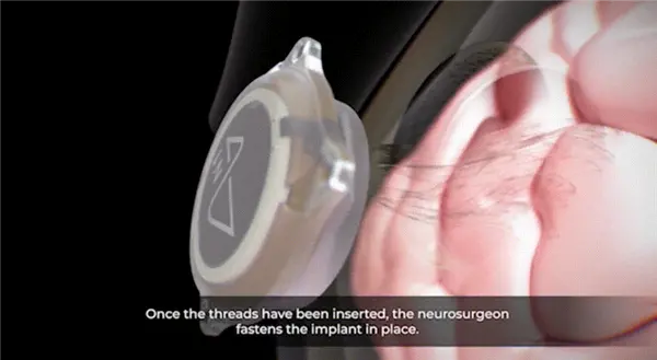 1.5秒植入！马斯克脑机接口公司技术新突破 超万人等待上脑