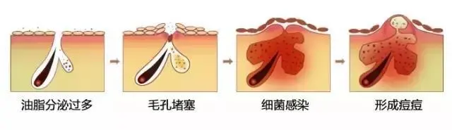 脸上长痘痘能不能抠 自我鉴定是否需要挤痘痘 挤痘痘到什么程度停