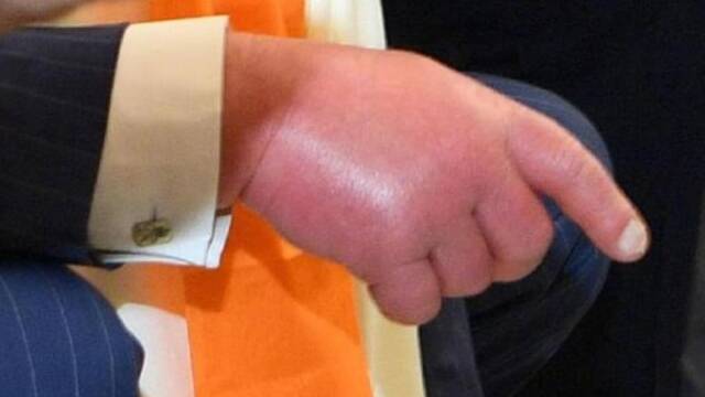 查尔斯王子出访印度 第一天就手脚红肿