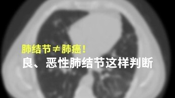 肺结节是肺癌的早期表现吗？