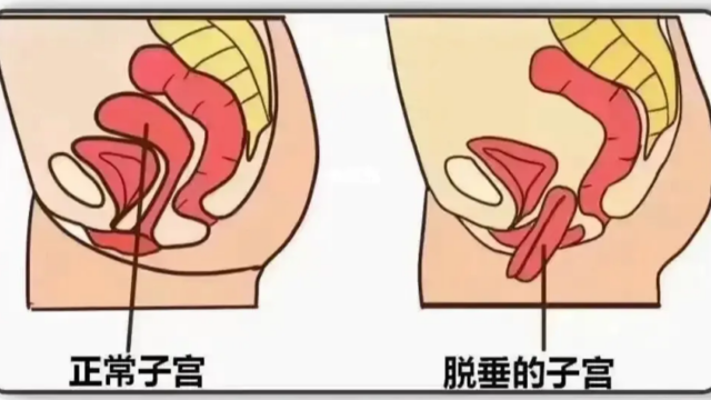 子宫脱垂不再难“托”：科学治疗重塑生命支撑