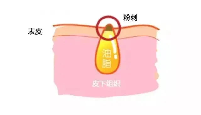 脸上长痘痘能不能抠 自我鉴定是否需要挤痘痘 挤痘痘到什么程度停