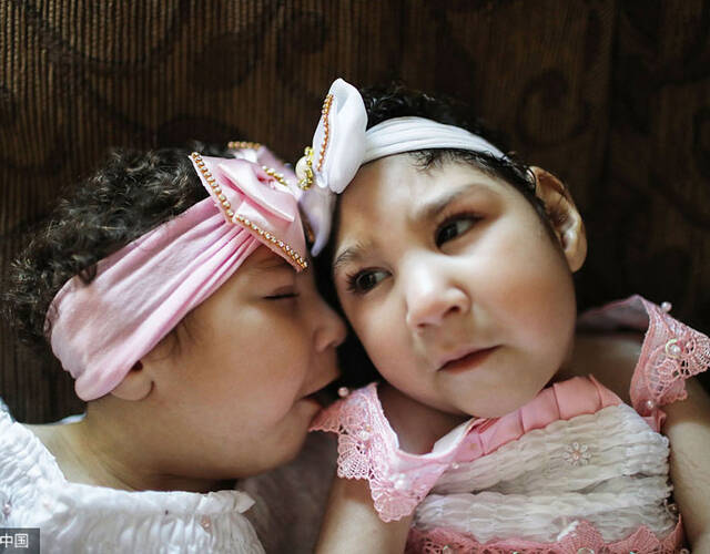 巴西患小头畸形症双胞胎庆一周岁生日