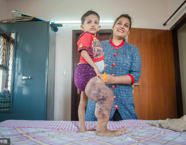 akshaj患有一种叫做静脉畸形骨肥大综合征的罕见遗传病,他的一条腿是