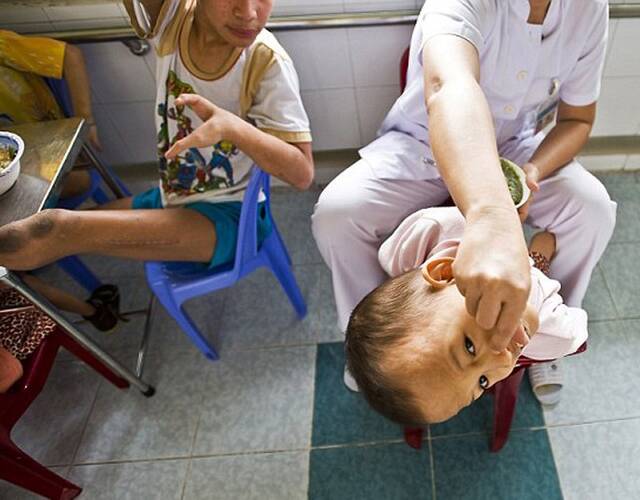 越战遗留化学试剂致婴儿畸形