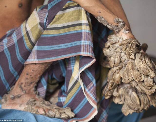 怪病男子:手脚增生如树根